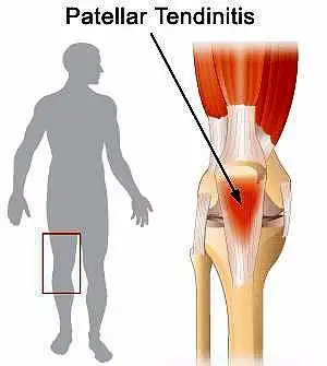 jumpers knee跳躍膝,也就是髕骨肌腱炎,patella tendonitis是運動