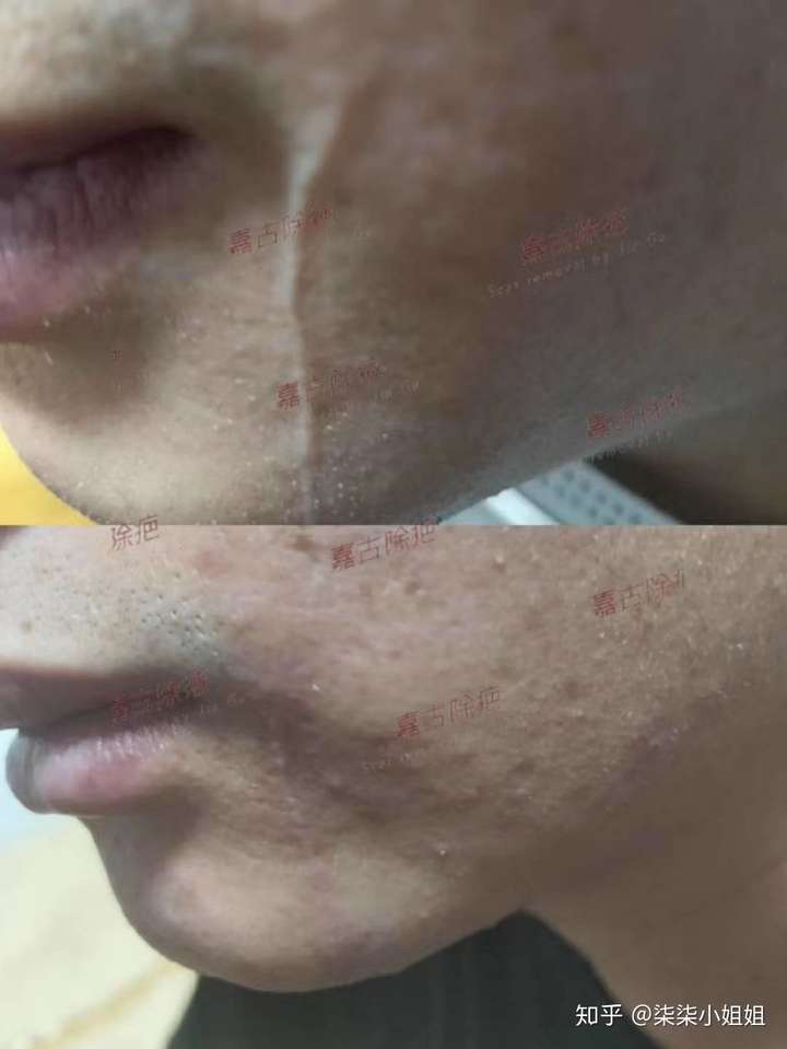 白色疤痕 微微凸起 线型白色疤痕 最近很多人咨询白疤问能不能修复
