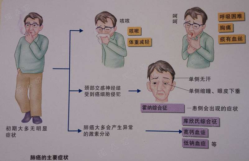 肺癌的科普防治及保障方案 知乎