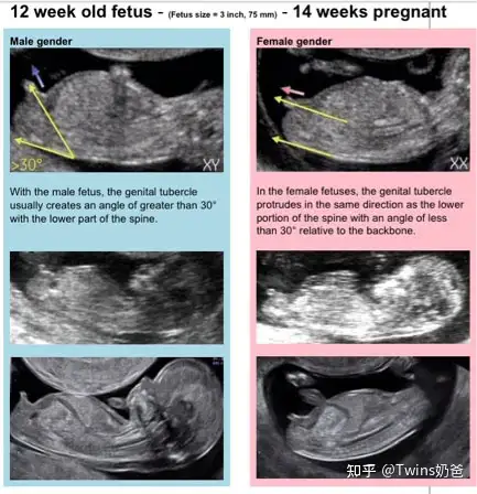 Nub理论是什么 怎么在孕期判断胎儿的性别是男宝女宝 知乎