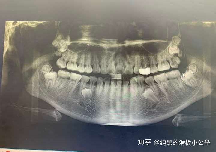 好羡慕,我智齿有十二颗 会不会有人不信啊  那俺放个片子好了