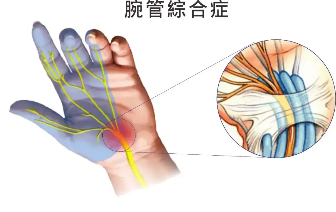 80 的白领学生党都中枪的 鼠标手 应该怎么破 知乎