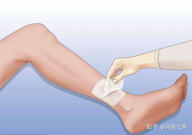 引流技术(vsd)是指用内含有引流管的聚乙烯酒精水化海藻盐泡沫敷料,来