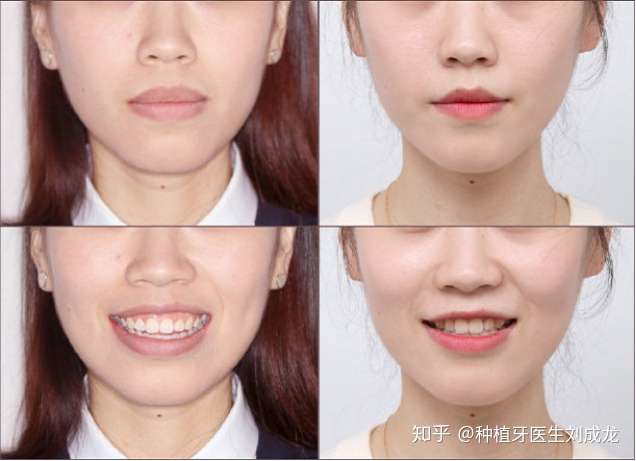 有点兔牙 怎么矫正一下 能用隐适美吗 坐标郑州 有推荐的医院和医生吗