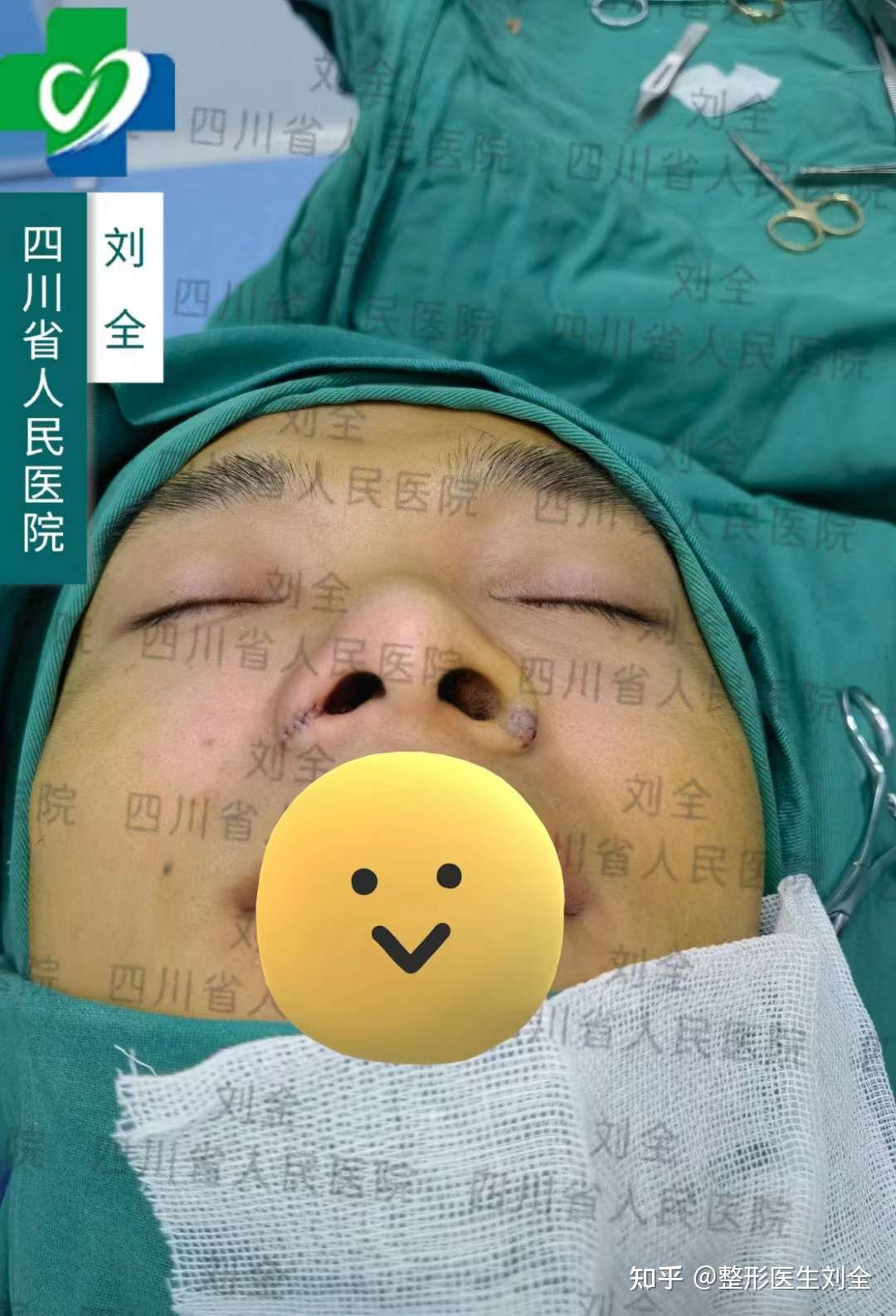 整形医生刘全 的想法: 鼻翼内切单侧对比 很多想只做鼻翼切除 可