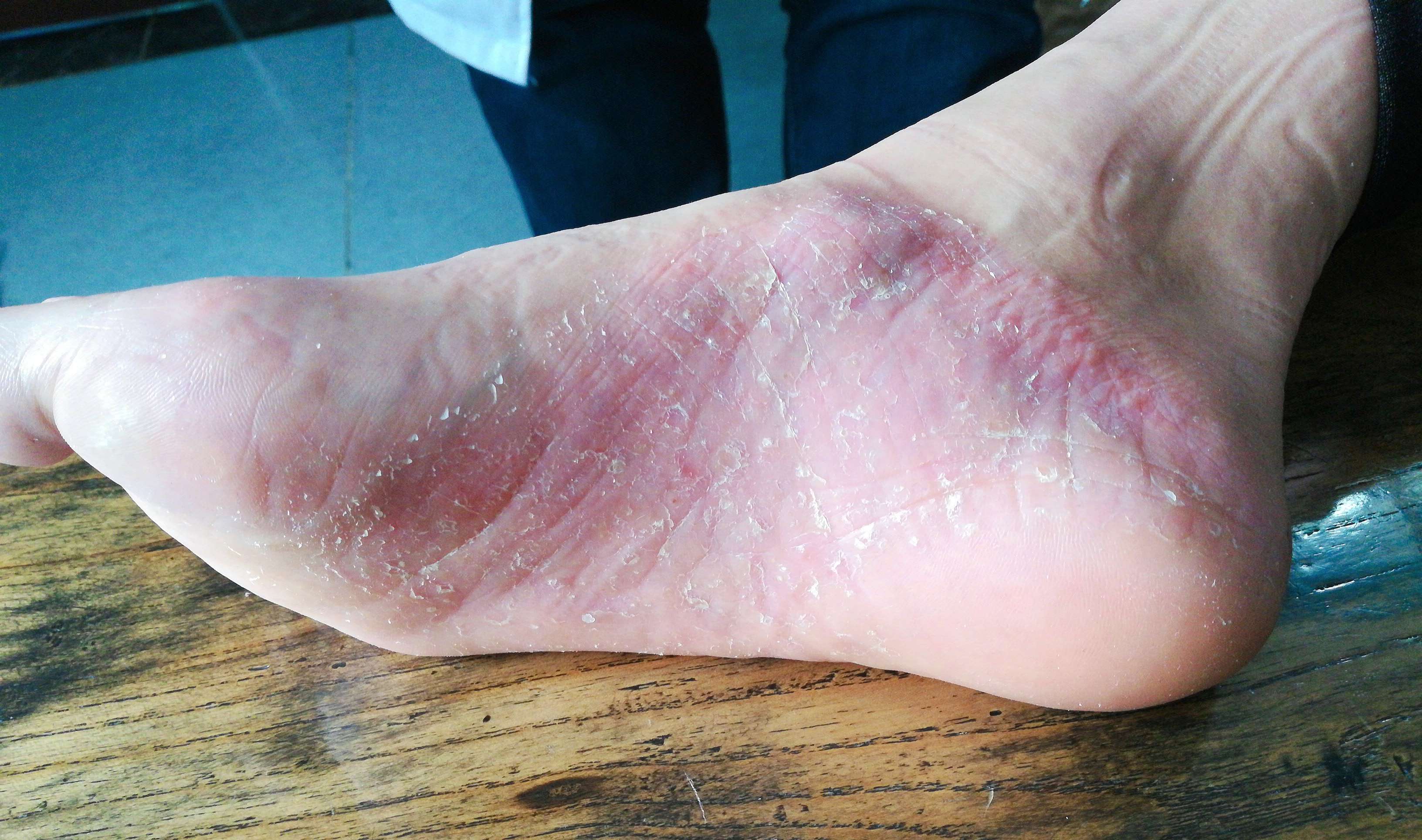 皮肤医生李志忠 的想法: #掌跖脓疱病# 今天接诊的一位掌跖脓疱病