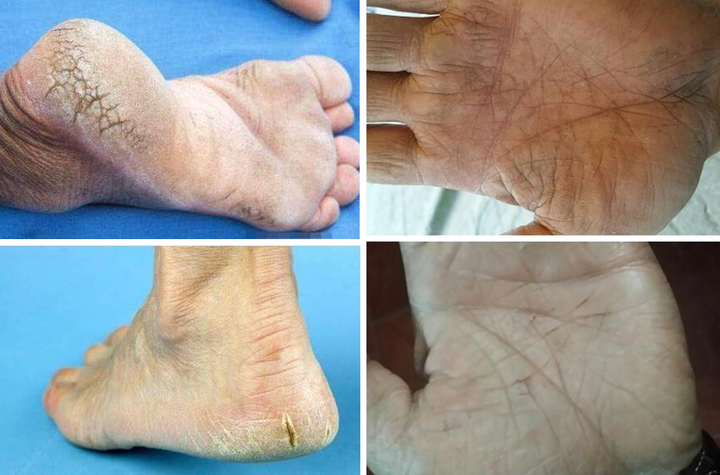 冬天干燥皮肤异常干裂脱皮重度缺水脚板边缘和脚后跟开裂特别严重痛得