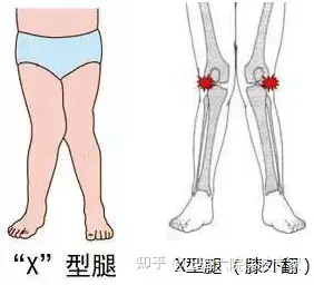 膝盖骨往外偏图片图片