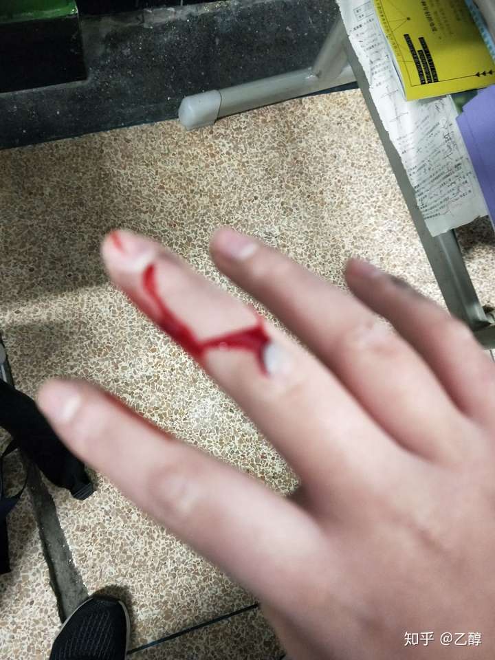 「已注销」 2 人赞同了该回答 我在手上划了几道口子,现在还有疤,每天