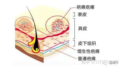 增生性疤痕的形成和日常护理须知