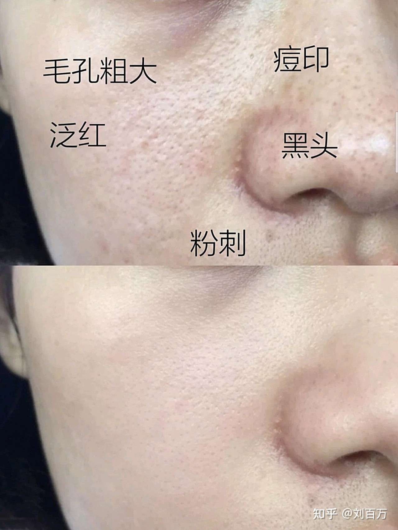 毛孔粗大怎么办 如何改善 医美or护肤 毛孔粗大必看 知乎