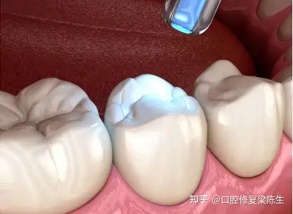 进口玻璃离子补牙目前市面上常用的补牙材料有