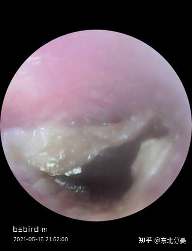 耳朵几乎每隔一个月就会有分泌物堵住有图