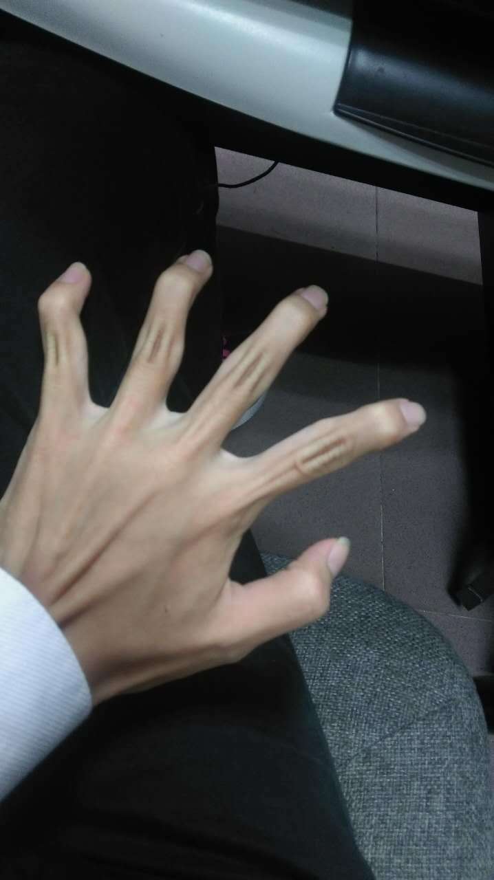 手指弯曲是什么原因造成的