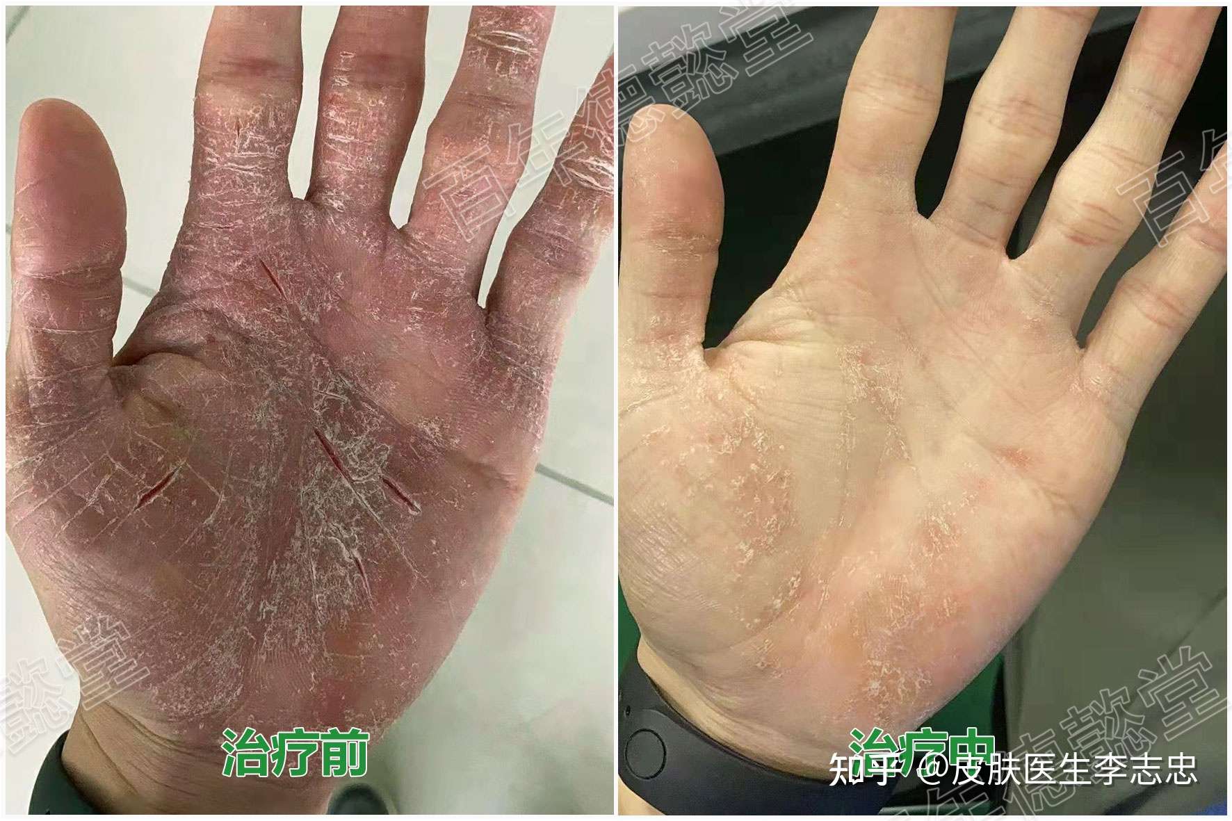 皮膚醫生李志忠 的想法: 皸裂性溼疹,主要表現為浸潤,肥厚,乾燥