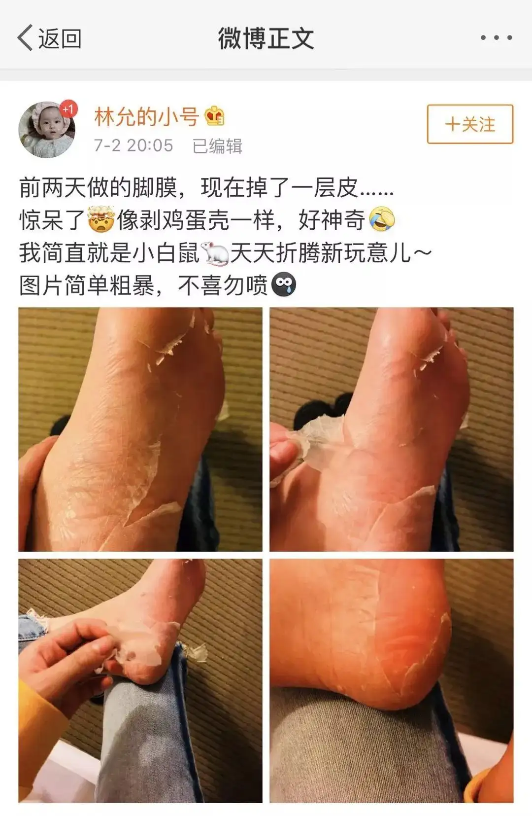 林允公开撕脚皮安利足膜 关于足部护理 小编却只想安利泡脚推广大使吴昕 知乎 林允公开撕脚皮安利足膜 关于足部护理 小编却只想安利泡脚推广大使吴昕 知乎