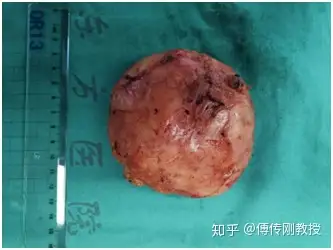 痔疮直肠癌原来元凶还有他骶前肿瘤