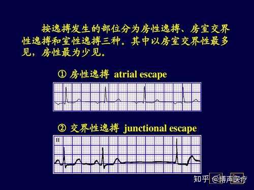 逸搏心律什么意思图片