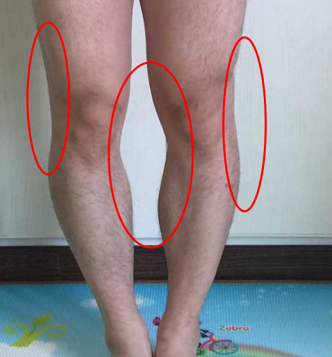 双腿内外侧凹陷,内侧的影响更大一些,可以考虑自体脂肪移植,把凹陷的