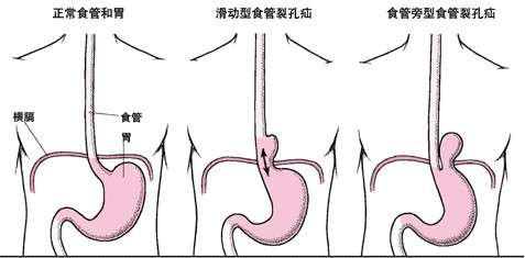 胃的形狀大小和位置有個體差異,即使在同一個