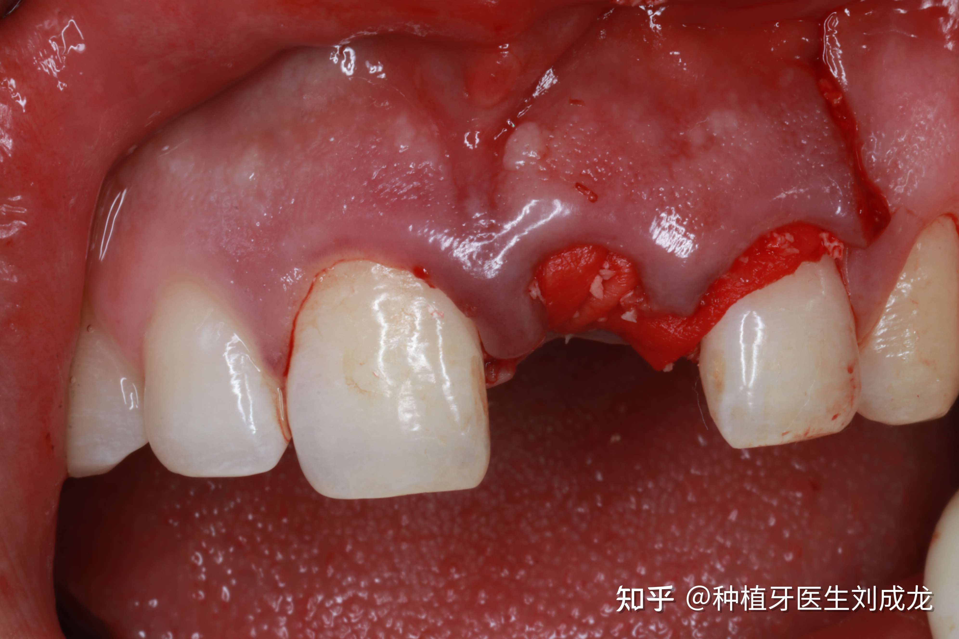 种植牙医生刘成龙 的想法: 【门牙即拔即种案例】#郑州种植牙# 男性