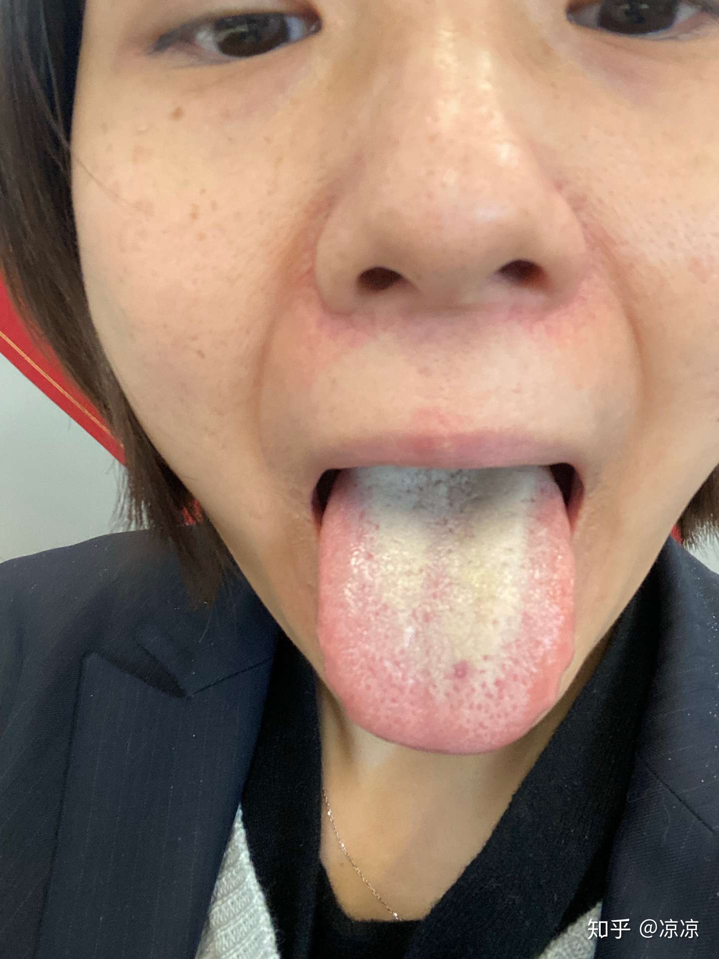 舌苔的变化 知乎