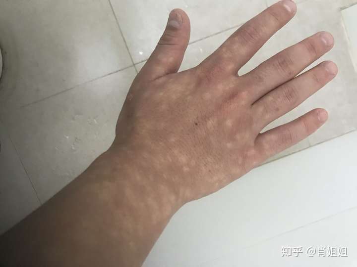 马歇尔怀特综合症 希望有办法治疗