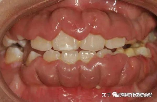 **,男,12岁,十二月一日经熟人介绍来邯郸市牙防所要求洁牙和治疗牙龈