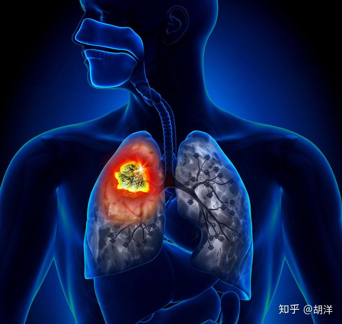 晚期小细胞肺癌患者已活过5年 他是如何做到的 综合治疗是秘诀 知乎