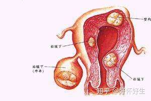 一般來說,大部分子宮肌瘤對女性懷孕的影響不是太大,因為子宮肌瘤生長