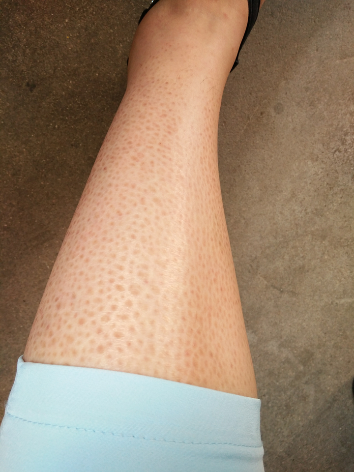 我姥爷总说我是蛇皮身. 如下图,(大家不要嘲笑我,够自卑了)