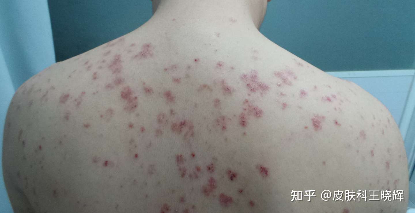 银屑病的病名来历 牛皮癣 知乎