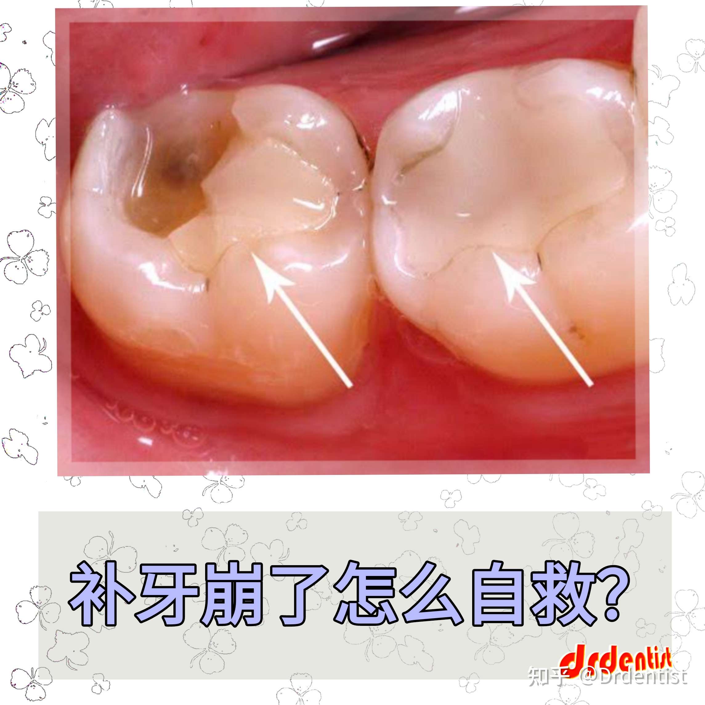 drdentist 的想法: #drdentist知会齿# 补过的牙齿崩了一小块