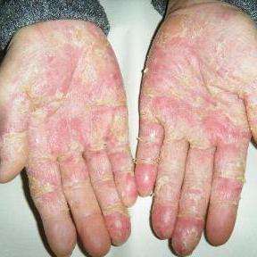 手蜕皮(又称为手掌蜕皮症),该病好发于手掌,手指的掌面及足底.