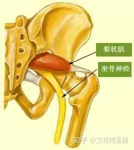 一,梨状肌综合征是指梨状肌部位疼痛紧张,卡压坐骨神经,引起臀部疼痛