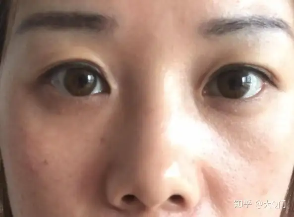 北京八大处假体隆鼻和全切双眼皮初体验丨八大处整形鼻子谁做的好