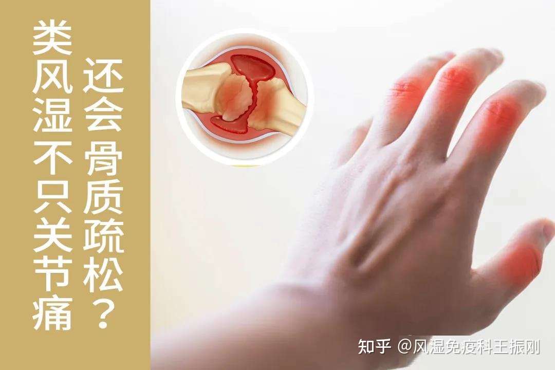 女性类风湿关节炎患者易发生骨质疏松 有四种原因需做好五点预防 知乎