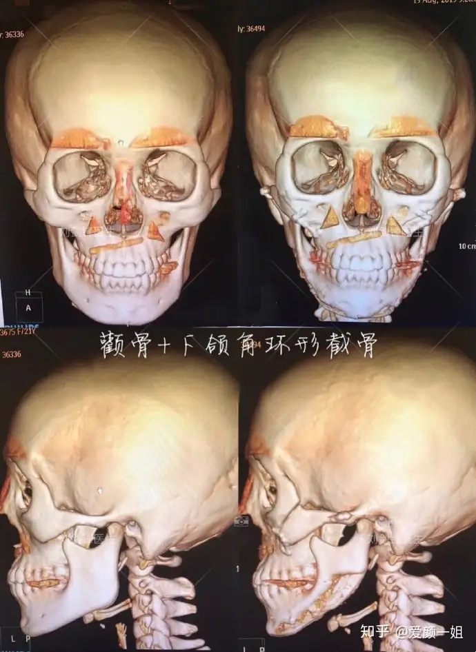北京颧骨➕下颌角截骨去外板➕去颊脂垫分享- 知乎