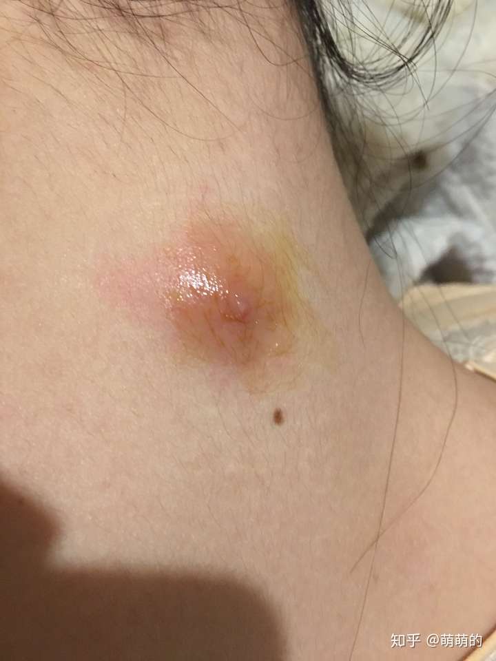 黑头大到直接挤出来是什么感受?