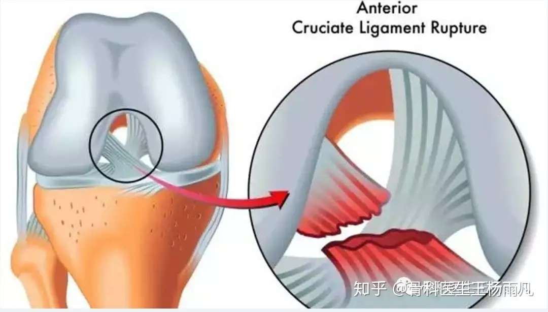 我的膝盖是怎么了 造成膝盖疼痛的十几种常见原因 知乎