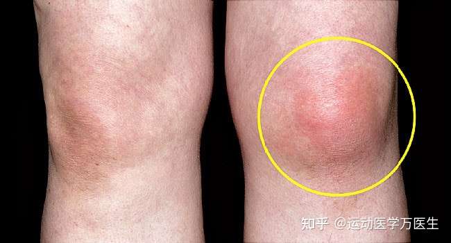 膝关节 莫名其妙 肿起来了 怎么办 知乎