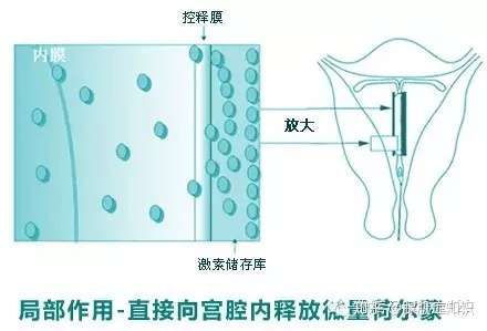 曼月樂環造成的月經時間長怎麼辦