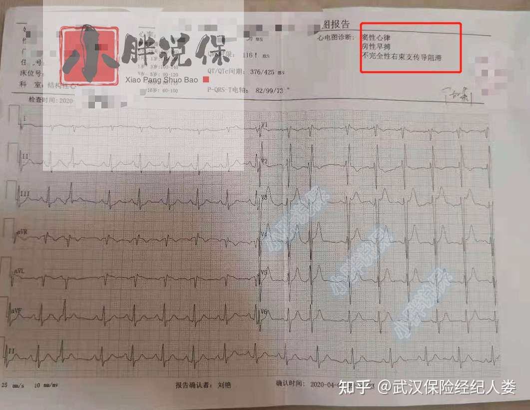 核保实例 三尖瓣返流 不完全性右束支传导阻滞 房性早搏重疾险标准体承保 知乎