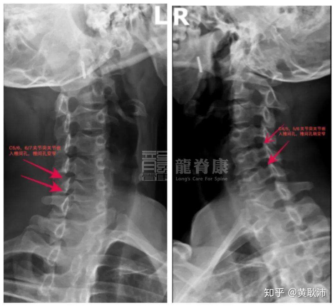 颈椎间盘突出需要手术吗 什么情况下建议手术 知乎