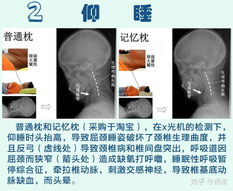 颈椎病患者如何挑选枕头 知乎