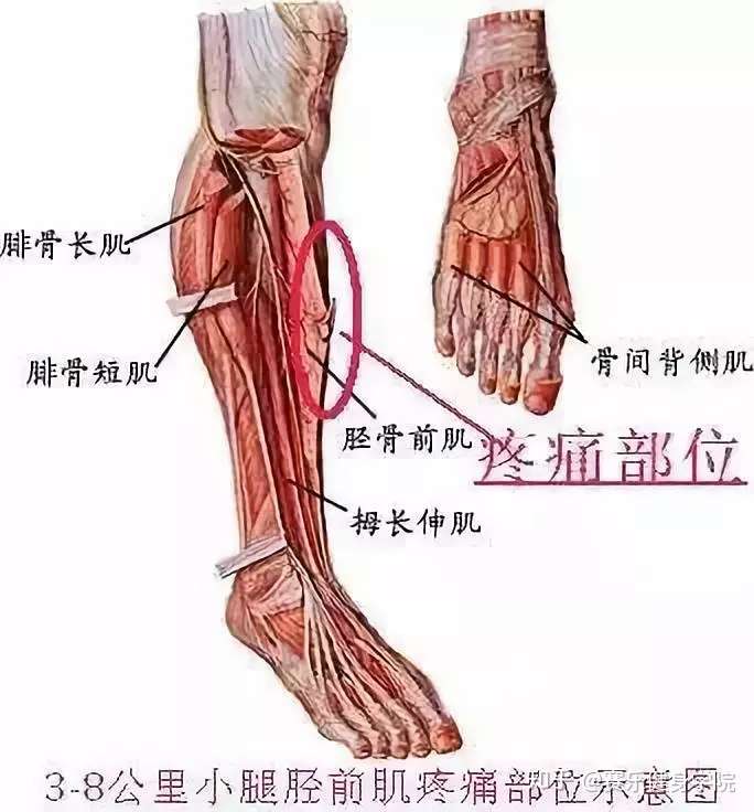 跑步时小腿前侧疼痛不容忽视 1 知乎