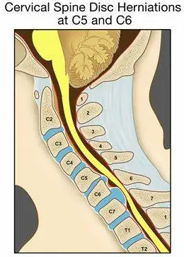 个案分析09颈部椎间盘突出挤压神经