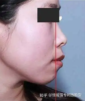 你适合做下巴截骨前移吗