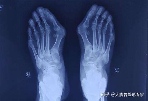 您见过大拇趾关节凸起吗30分钟就能有效矫正大脚骨
