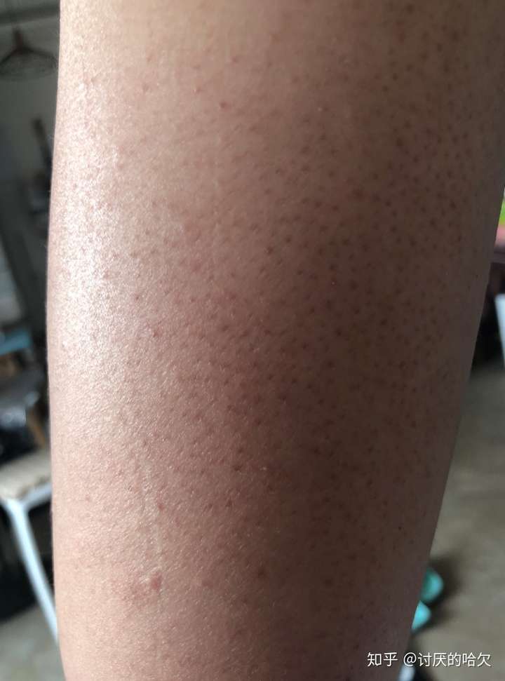 鸡皮肤可以完全根治么(鸡皮肤可以完全根治么嘛)